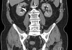 Overactive Bladder Found to Raise Nocturia Risk Overactive Bladder Found to Raise Nocturia Risk