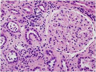 Vitamin D May Suppress Prostate Tissue Inflammation Vitamin D May Suppress Prostate Tissue Inflammation