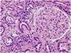 An Inflammatory Case of Acute Kidney Injury An Inflammatory Case of Acute Kidney Injury
