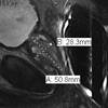 Is "Fusion" Technology Heralding the "Anatomic" Age for Prostate Biopsy? Is "Fusion" Technology Heralding the "Anatomic" Age for Prostate Biopsy?