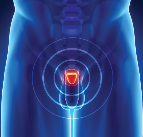 Brachytherapy Offers Favorable Long Term Prostate Cancer