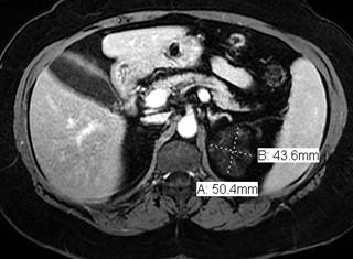 Tumor flare from discontinuation of sunitinib and pazopanib associated with decreased survival. Tumor flare from discontinuation of sunitinib and pazopanib associated with decreased survival.