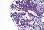 Possible Tissue Injury Predictor in Transplant Recipients Found Possible Tissue Injury Predictor in Transplant Recipients Found