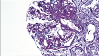 FSGS: Talking Points for the Practicing Nephrologist