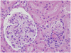 Assessing Prognosis in a Common Type of Glomerulonephritis? Assessing Prognosis in a Common Type of Glomerulonephritis?