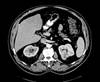 Risk of Urine Leak After Nephron-Sparing Surgery Risk of Urine Leak After Nephron-Sparing Surgery