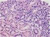 Rising Creatinine After Renal Transplantation Rising Creatinine After Renal Transplantation