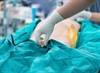 Transurethral Resection (TUR) Bladder Perforation May Worsen Outcomes Transurethral Resection (TUR) Bladder Perforation May Worsen Outcomes