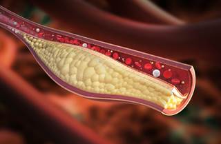 Findings suggest that normalization of blood fats may reduce risk of prostate cancer. Findings suggest that normalization of blood fats may reduce risk of prostate cancer.