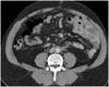 A Strange Case of Post-Renal Acute Kidney Injury A Strange Case of Post-Renal Acute Kidney Injury