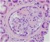 An Unusual Nodular Glomerular Lesion An Unusual Nodular Glomerular Lesion