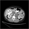 Residual Retroperitoneal Mass Following Chemotherapy for Testicular Cancer Residual Retroperitoneal Mass Following Chemotherapy for Testicular Cancer