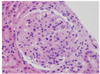 A Young Woman with Diffuse Proliferative Glomerulonephritis