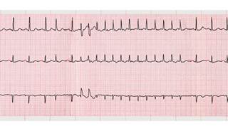 atrial fibrillation atrial fibrillation