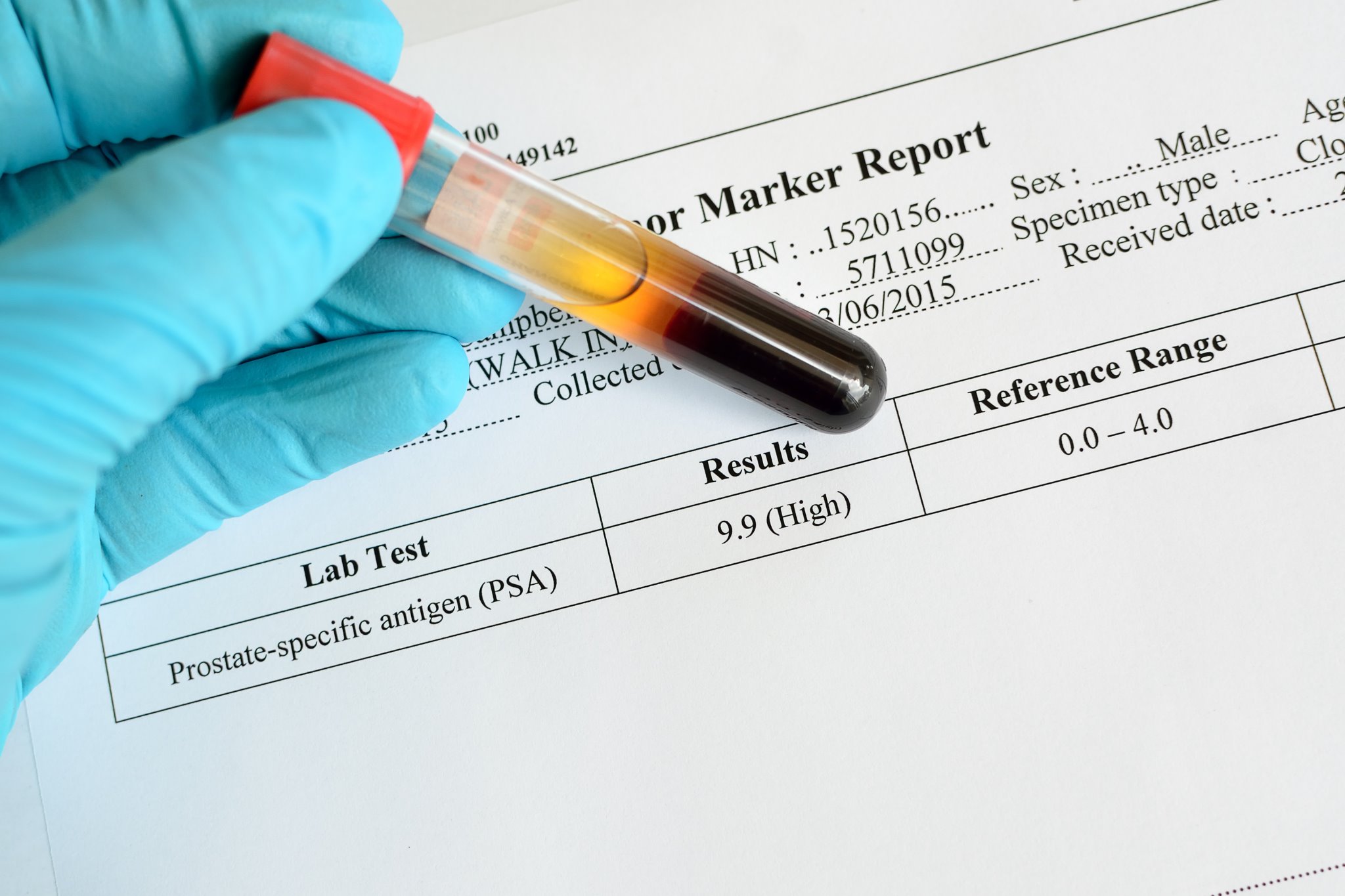 pca-cryoablation-achieves-acceptable-outcomes-renal-and-urology-news