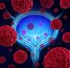 Bladder Cancer Progression Linked to Collagen Changes Bladder Cancer Progression Linked to Collagen Changes