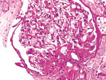 Obesity and Kidney Disease: Hidden Consequences of the Epidemic Obesity and Kidney Disease: Hidden Consequences of the Epidemic
