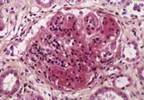 SLE Renal Outcomes With Mixed LN and Pure Proliferative LN Compared SLE Renal Outcomes With Mixed LN and Pure Proliferative LN Compared