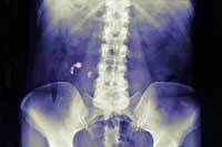 Medical expulsion therapy increased stone passage rate by 29%, meta-analysis showed. Medical expulsion therapy increased stone passage rate by 29%, meta-analysis showed.
