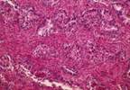 Low Testosterone May Signal Need for PCa Reclassification Low Testosterone May Signal Need for PCa Reclassification