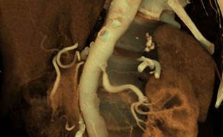 Renal stents are not better tha noptimal medical therapy alone for renal artery stenosis. Renal stents are not better tha noptimal medical therapy alone for renal artery stenosis.