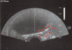 Focal Therapy for Low-Risk Prostate Cancer Focal Therapy for Low-Risk Prostate Cancer