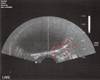 Focal Therapy for Low-Risk Prostate Cancer Focal Therapy for Low-Risk Prostate Cancer