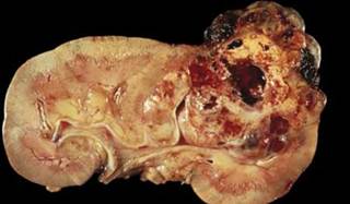 Hypertension Linked to RCC Hypertension Linked to RCC