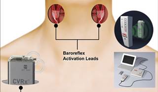 An investigational implantable device activates baroreceptors of the carotid sinus. An investigational implantable device activates baroreceptors of the carotid sinus.