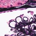 How a 'Glomerulonephritis Board' Can Help Improve Patient Care How a 'Glomerulonephritis Board' Can Help Improve Patient Care