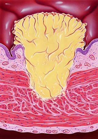 Trimodal Therapy Effective in Invasive Bladder Urothelial Carcinoma Not Suitable for Cystectomy Trimodal Therapy Effective in Invasive Bladder Urothelial Carcinoma Not Suitable for Cystectomy