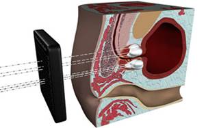 Cryoablation needles are inserted through the perineum into the prostate. Cryoablation needles are inserted through the perineum into the prostate.