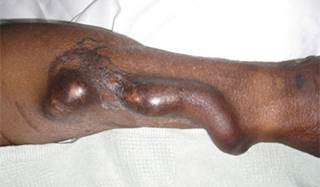 In a prospective study, aspirin users were more likely to have a successful outcome following PTA for venous stenoses in arteriovenous fistulas or grafts. In a prospective study, aspirin users were more likely to have a successful outcome following PTA for venous stenoses in arteriovenous fistulas or grafts.