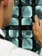 Robotic Prostate Surgery Implicated in PLND Decline Robotic Prostate Surgery Implicated in PLND Decline