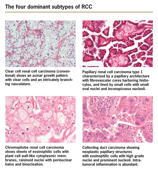 Classifying Histologic Subtypes of Renal Cell Carcinoma - Renal and ...