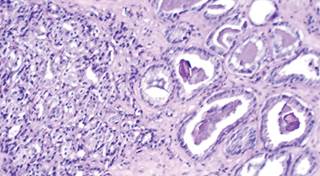 Relationships of Testosterone and Prostate Cancer: A 2011 Perspective Relationships of Testosterone and Prostate Cancer: A 2011 Perspective