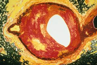 Vitamin D has indirectly been linked to the development of atherosclerosis (shown here). Vitamin D has indirectly been linked to the development of atherosclerosis (shown here).