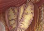 Enlarged Prostate Linked to Metabolic Syndrome Enlarged Prostate Linked to Metabolic Syndrome