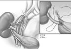 Renal ATPV for Intractable Stone Disease Renal ATPV for Intractable Stone Disease