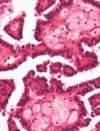 Classifying Histologic Subtypes of Renal Cell Carcinoma Classifying Histologic Subtypes of Renal Cell Carcinoma