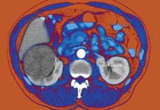 In a study, symptomatic tumors were larger than those detected incidentally. In a study, symptomatic tumors were larger than those detected incidentally.