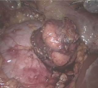 Female transplant recipients had significantly increased risk of urologic cancers. Female transplant recipients had significantly increased risk of urologic cancers.