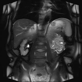 It is associated with a 20-fold increased likelihood of the malignancy, British study shows. It is associated with a 20-fold increased likelihood of the malignancy, British study shows.