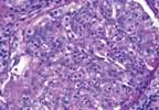 Improving Sensitivity of LN Urinary Markers by Combining Panels Improving Sensitivity of LN Urinary Markers by Combining Panels