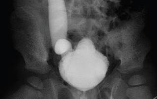 New Stone Risk Found in VUR Patients New Stone Risk Found in VUR Patients