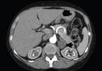 Unusual Manifestation of an Aldosterone-Producing Adenoma Unusual Manifestation of an Aldosterone-Producing Adenoma