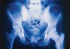 End-of-Life Prostate Cancer-Related Complications Characterized End-of-Life Prostate Cancer-Related Complications Characterized