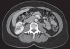 Page Kidney Resulting in New Onset Hypertension Page Kidney Resulting in New Onset Hypertension