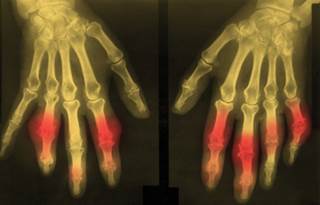 Individuals with first-degree relatives with gout are twice as likely to experienced gout. Individuals with first-degree relatives with gout are twice as likely to experienced gout.