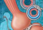 Bariatric Surgery Ups Kidney Stone Rates Bariatric Surgery Ups Kidney Stone Rates